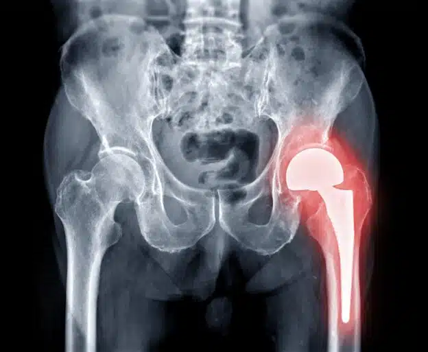 An x-ray showing a damaged hip joint.